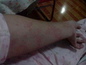 吃瓜过敏浑身红疙瘩,吃瓜引发的全身红疙瘩之谜